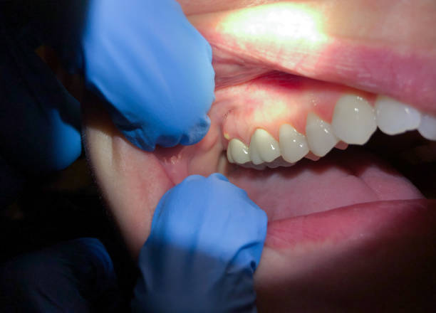 Best Emergency Wisdom Teeth Removal in Mitchell, IN